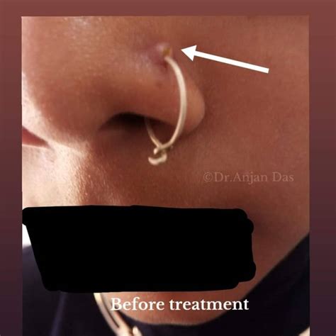 nose piercing bump won't go away|nose piercing bump inside itching.